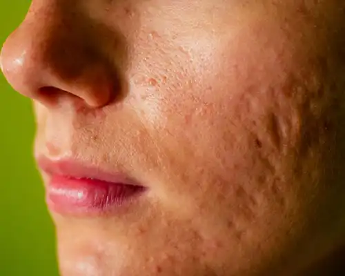 Acne and Acne scar Treatments