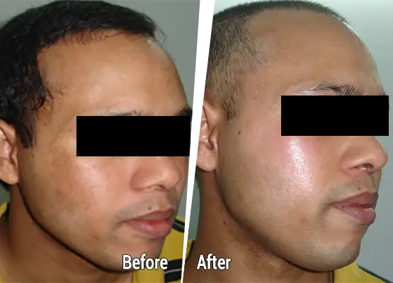Acne skin problem before after