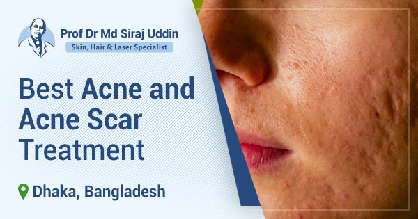 Best acne and acne scar treatment in Dhaka, Bangladesh