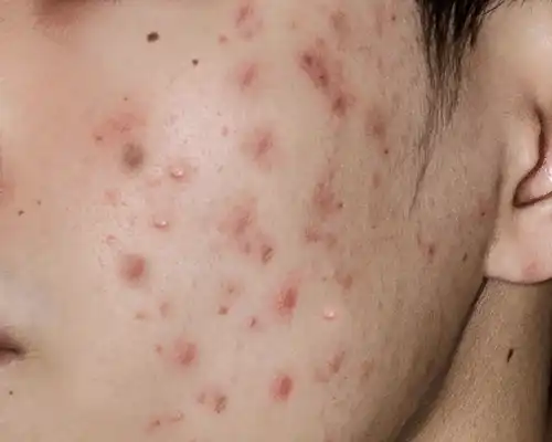 Acne