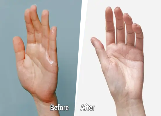 Advanced Botox Techniques for Hyperhidrosis