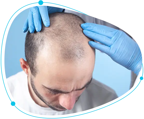 Best FUE hair transplant in Bangladesh