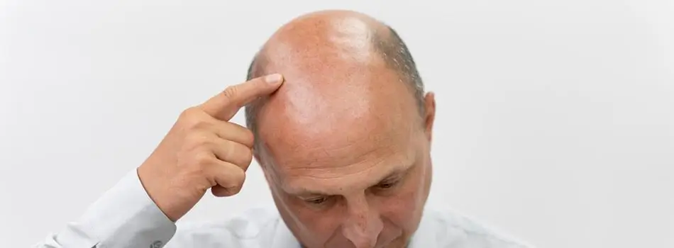 Best hair loss treatments for Men and Women in Bangladesh
