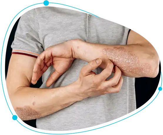 Best psoriasis specialist in Bangladesh