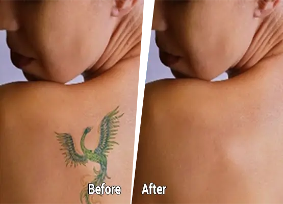 Best Tattoo Removal Treatment in Bangladesh