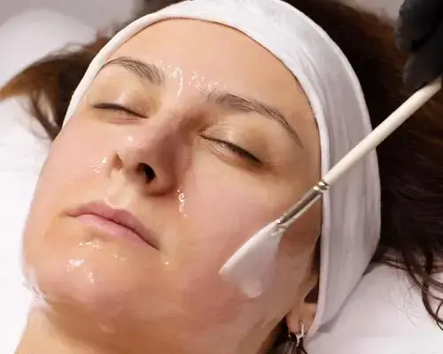 Chemical Peeling for Hyperpigmentation