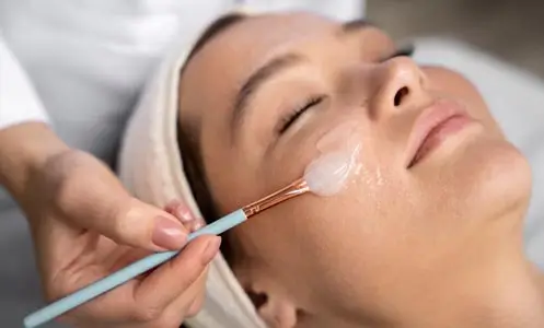 Chemical Peeling
