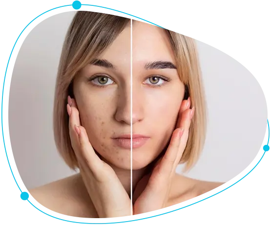 Chemical Peels Benefits