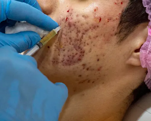 Chronic skin disease