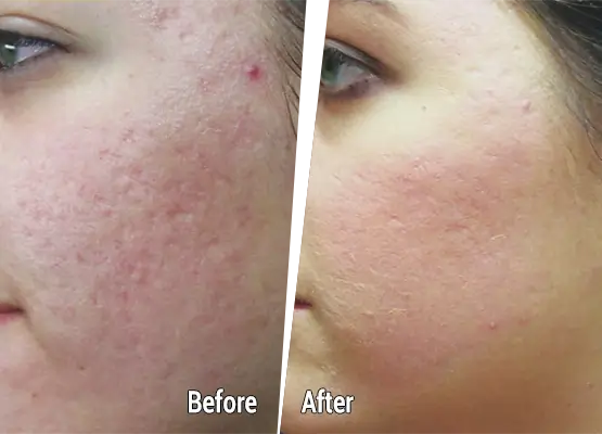 Dermapen 4 microneedling treatment before after