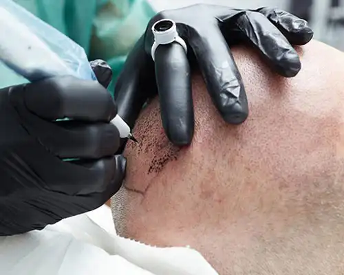 DHI hair transplant