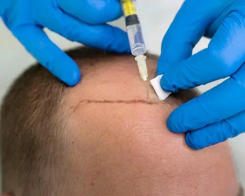 DHI (Direct Hair Implantation)