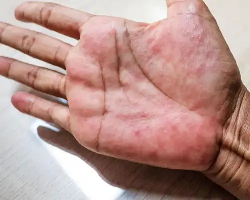 Eczema