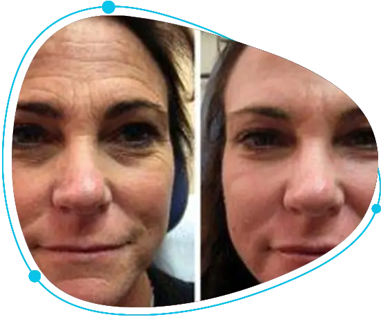 Experienced botox specialist