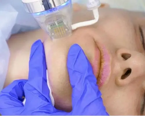 Fractional & Microneedle RF