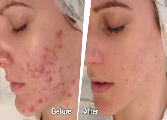 Fractional & Microneedle RF works before after
