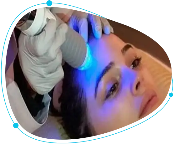 Fractional Microneedle RF treatment