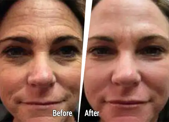 Fractional laser treatment before after