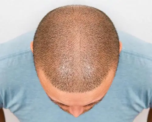 FUE hair transplant