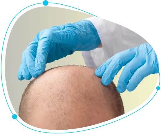 Hair growth surgery in Bangladesh