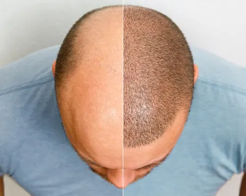 Hair transplant and restoration