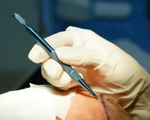 Hair Transplant by DHI