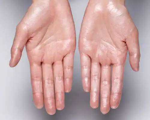 Hyperhidrosis