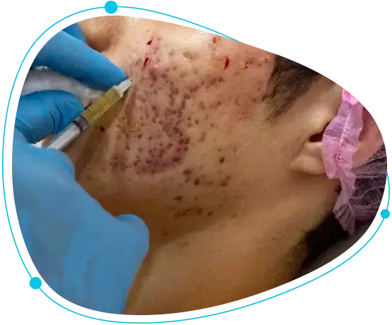 Hyperpigmentation treatment in Bangladesh