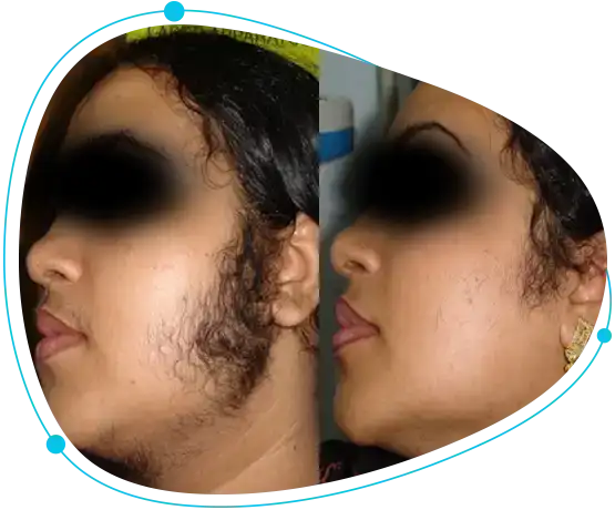 Laser hair removal treatment Benefits