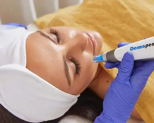 Laser Treatment for Hyperpigmentation