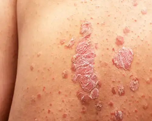Medical Dermatology