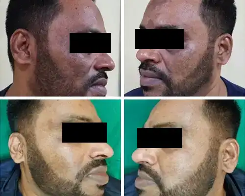 Medium-Depth Peels (TCA)
