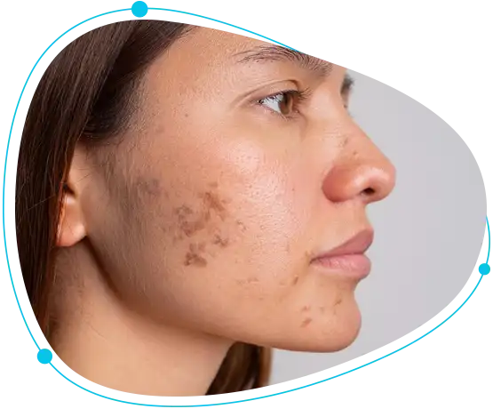 Melasma & Pigmentations treatment in Dhaka