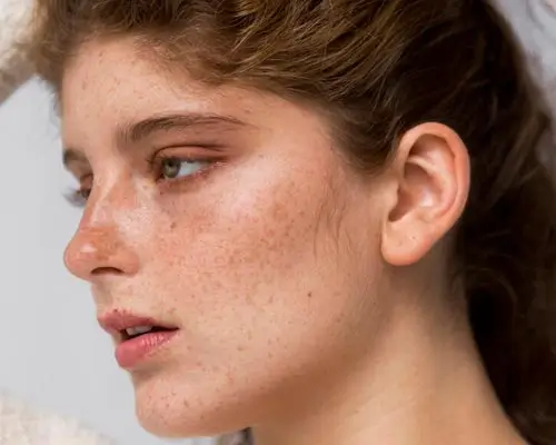 Melasma and pigmentation
