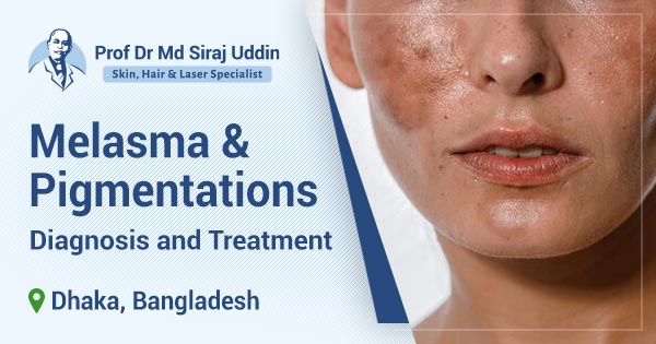 Melasma & Pigmentations: Diagnosis and treatment in Dhaka