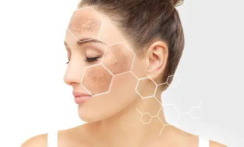 Melasma & Pigmentations