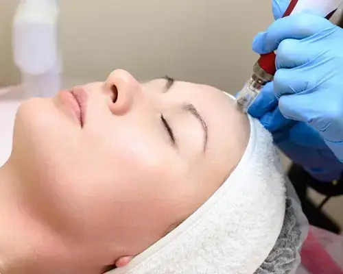 Microdermabrasion for Hyperpigmentation