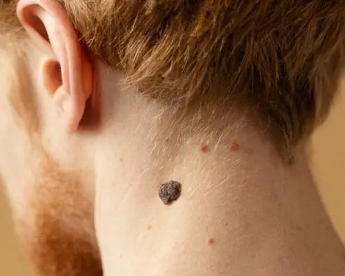 Moles