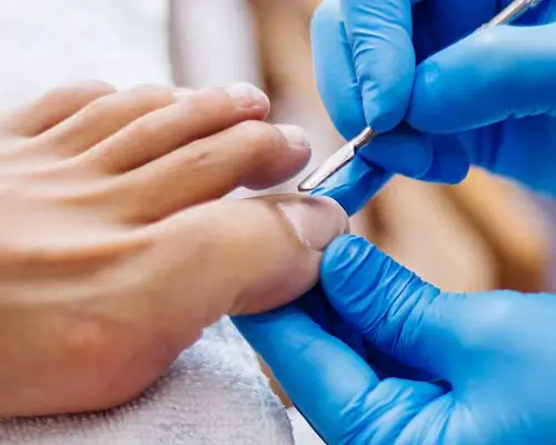 Nail diseases