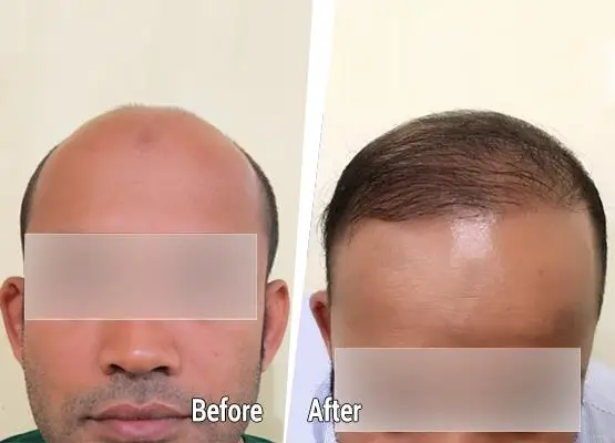 Natural and lasting results before after
