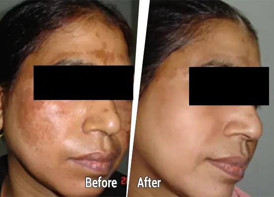 Pigmentation removal laser therapy