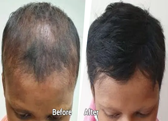 PRP hair restoration men women before after