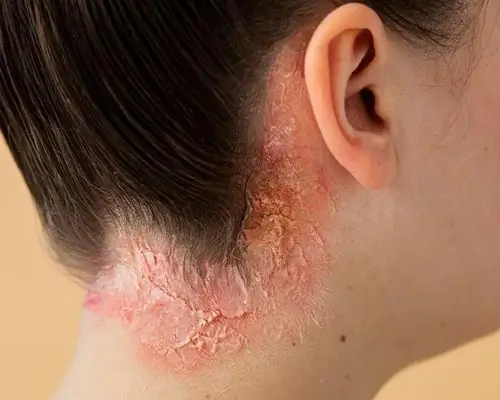 Psoriasis