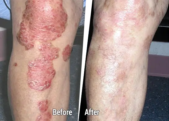 Psoriasis Common types