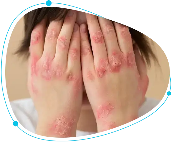 Psoriasis treatment in Bangladesh