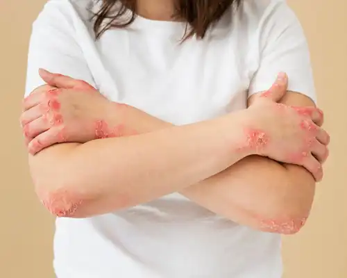 Psoriasis treatment