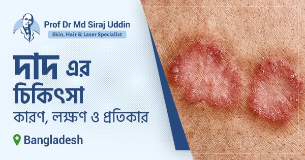 দাদ এর চিকিৎসা: কারণ, লক্ষণ ও প্রতিকার । ডা. সিরাজ উদ্দিন