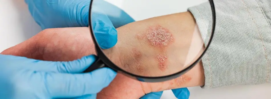 দাদ এর সাধারণ লক্ষণ (Ringworm Symptoms)