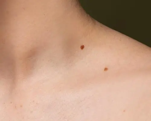 Skin tags