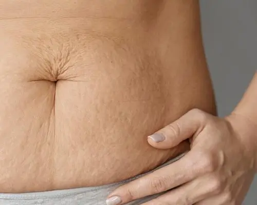 Stretch marks